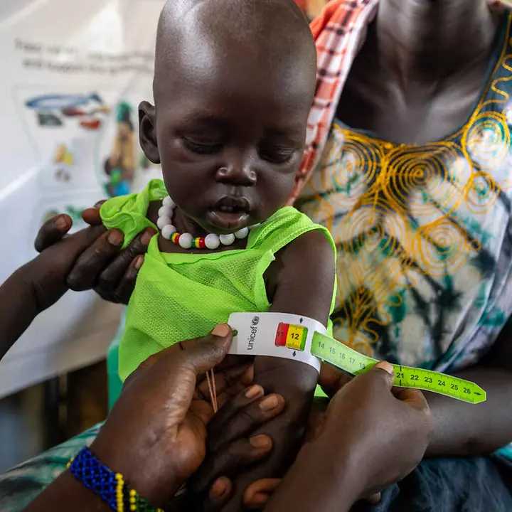 Südsudan Hungerkrise: Ein Kleinkind wird auf Mangelernährung untersucht.